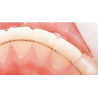 Arc de contention orthodontique (Retainer wire)