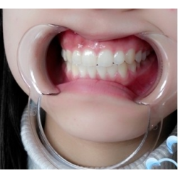 Cheek Retractor