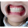 Cheek Retractor
