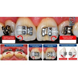 Ligatures de derotation (2Pcs)
